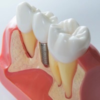 shutterstock_243013531.jpg Implant1