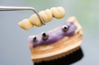 shutterstock_70384210.jpg Implant2